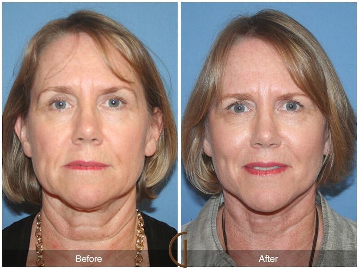 Eyelid Lift Before & After Gallery - Patient 232729 - Image 2