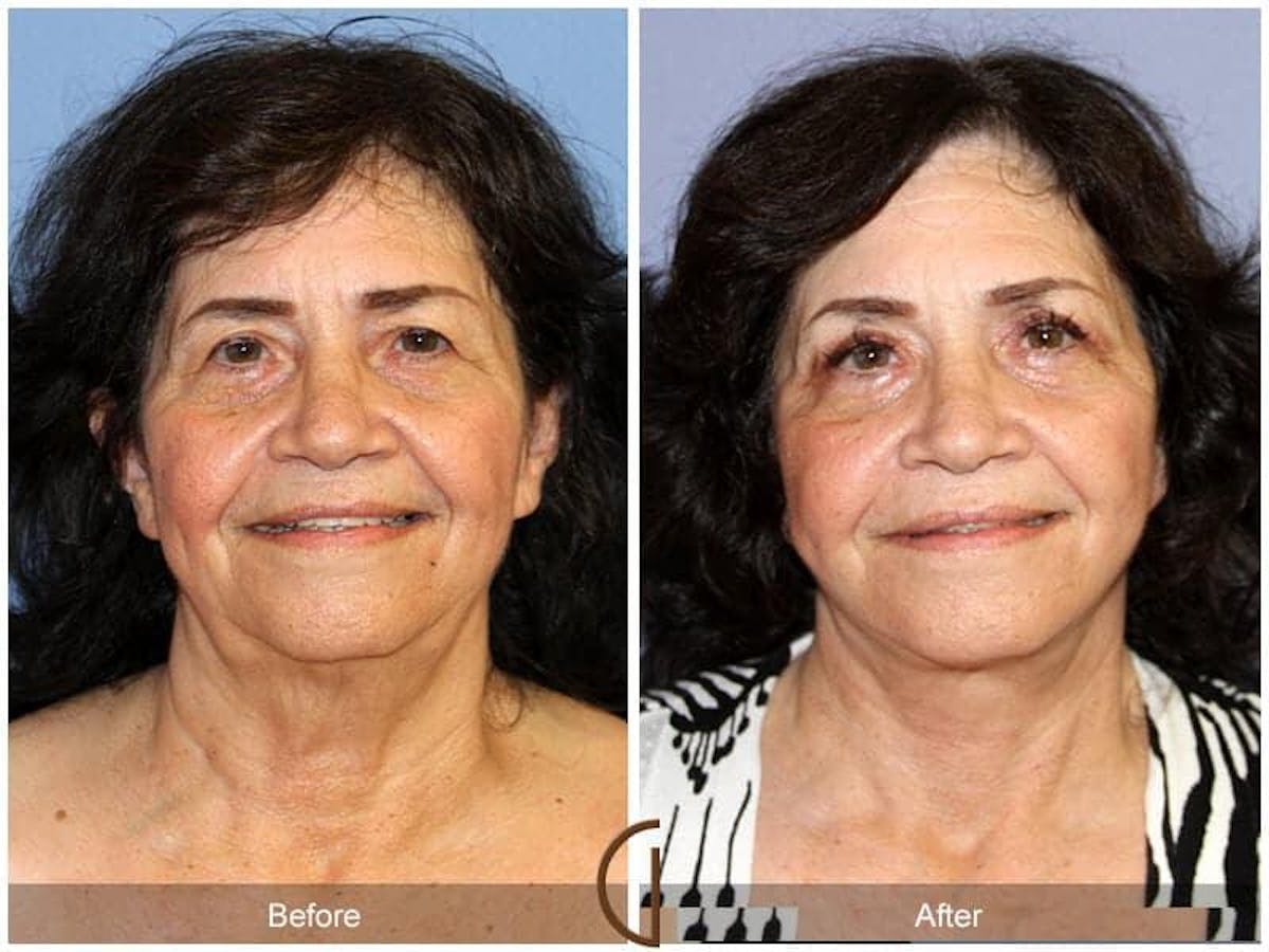 Eyelid Lift Before & After Gallery - Patient 211124 - Image 2