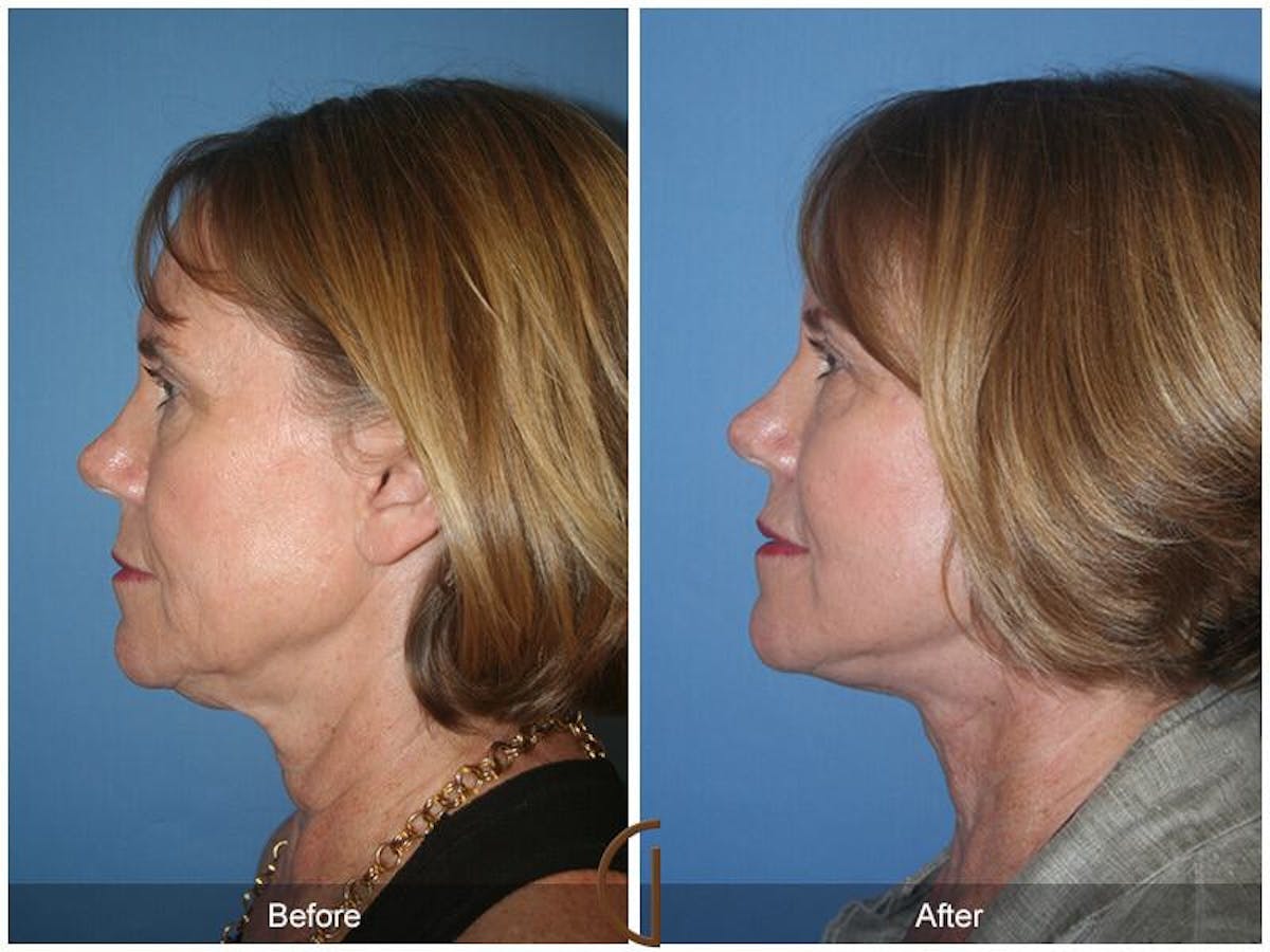 Eyelid Lift Before & After Gallery - Patient 232729 - Image 1