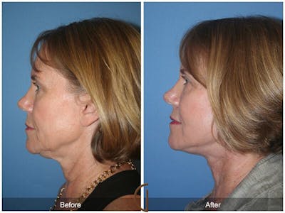 Eyelid Lift Before & After Gallery - Patient 232729 - Image 1