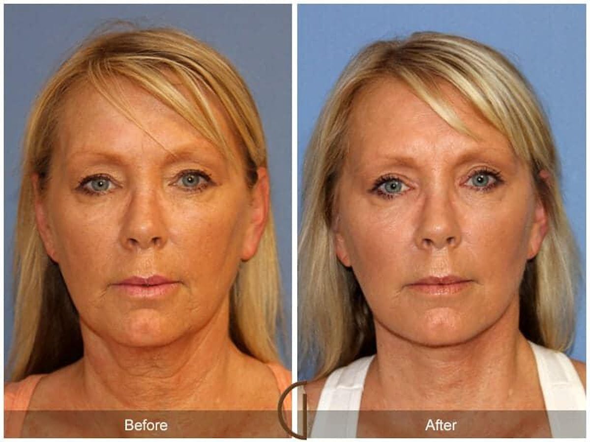 Eyelid Lift Before & After Gallery - Patient 627028 - Image 2