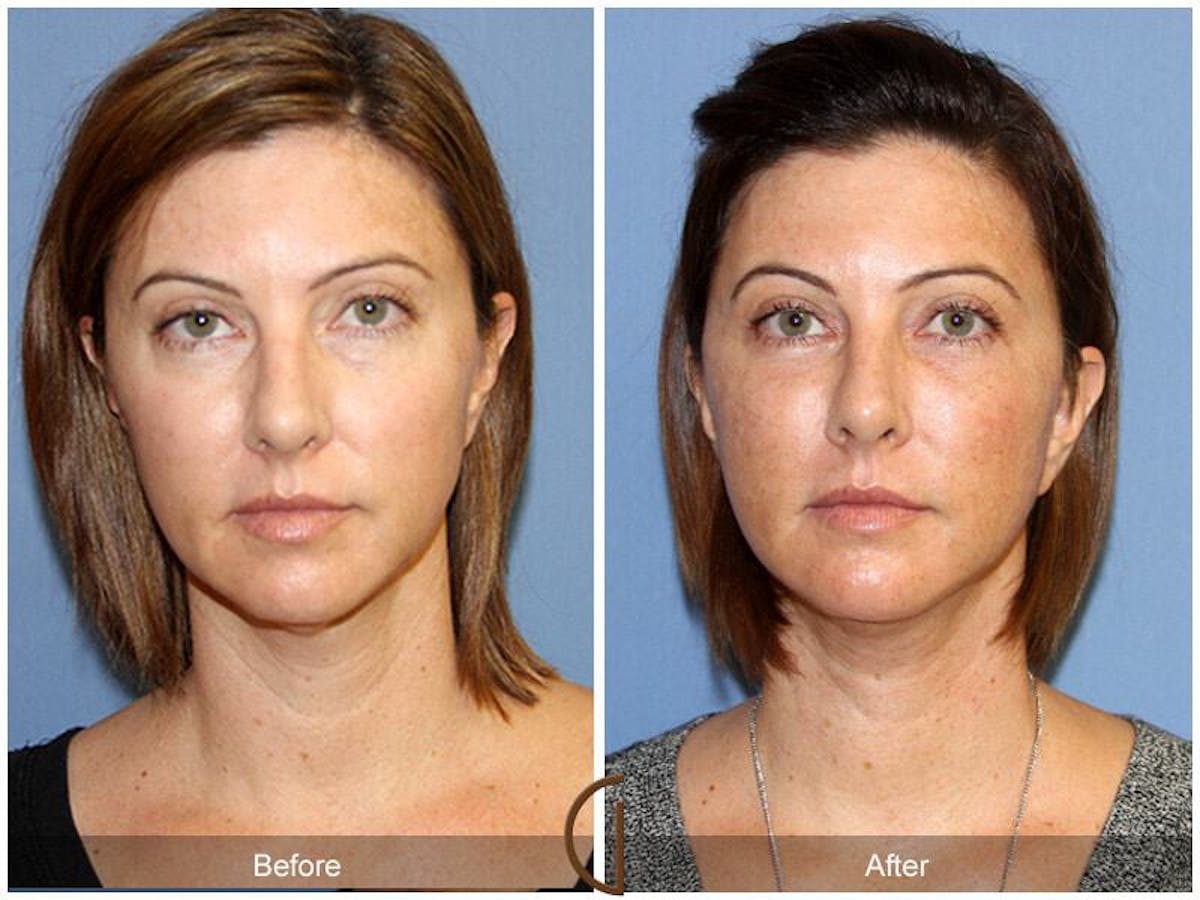 Eyelid Lift Before & After Gallery - Patient 476029 - Image 2