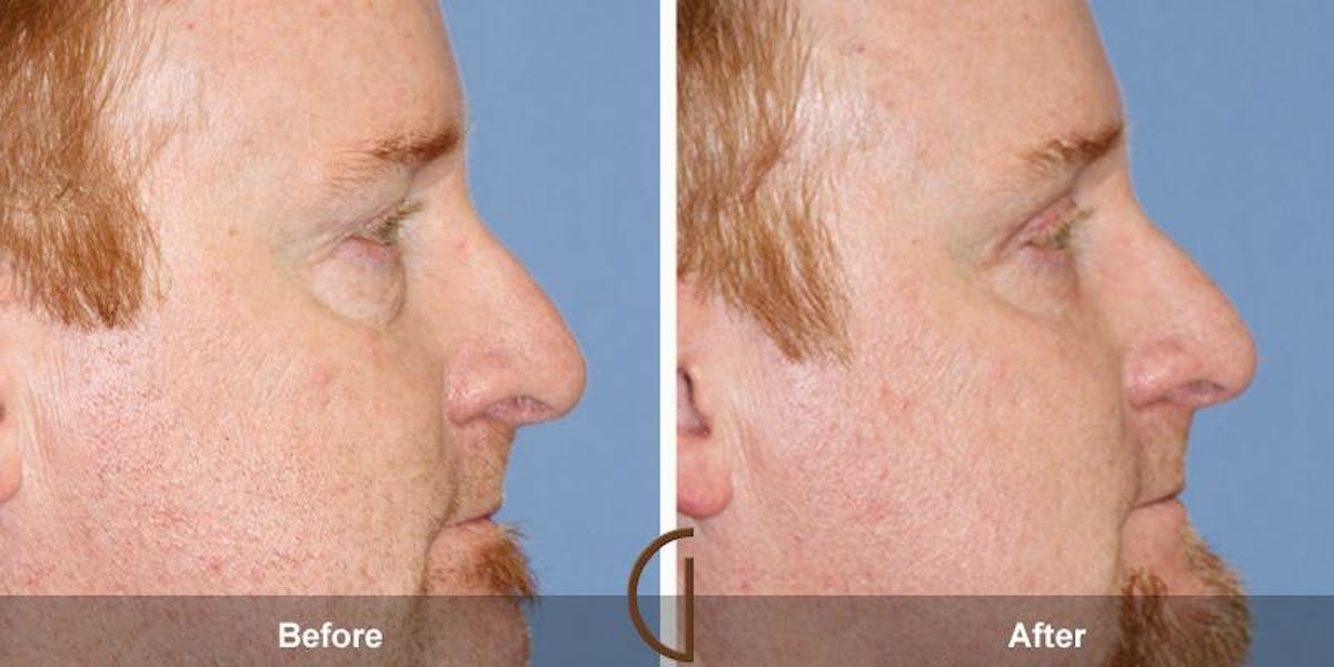 Eyelid Lift Before & After Gallery - Patient 732860 - Image 3
