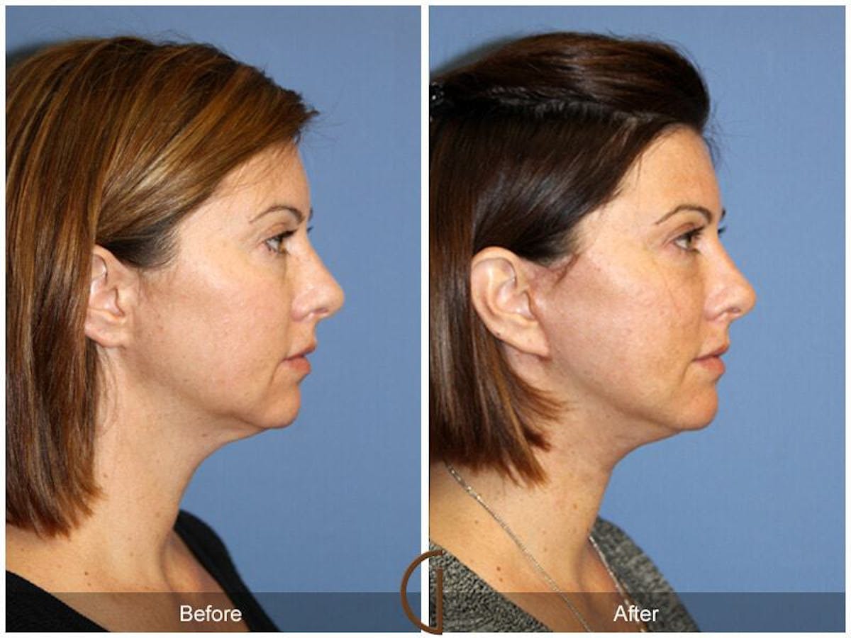Eyelid Lift Before & After Gallery - Patient 476029 - Image 3