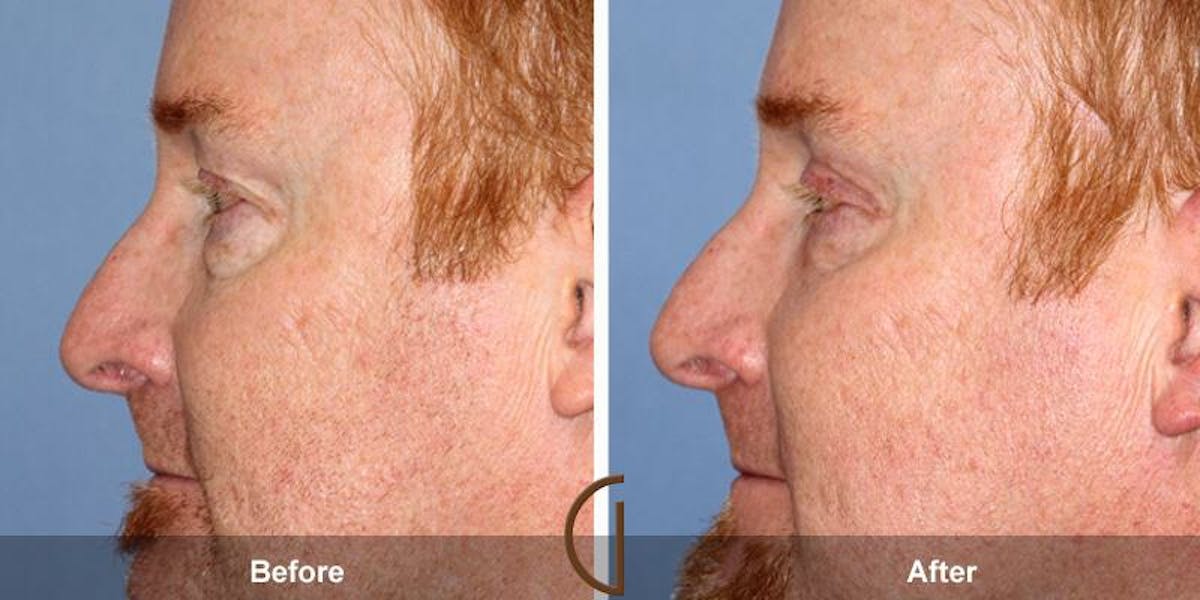 Eyelid Lift Before & After Gallery - Patient 732860 - Image 1