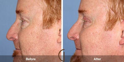Eyelid Lift Before & After Gallery - Patient 732860 - Image 1