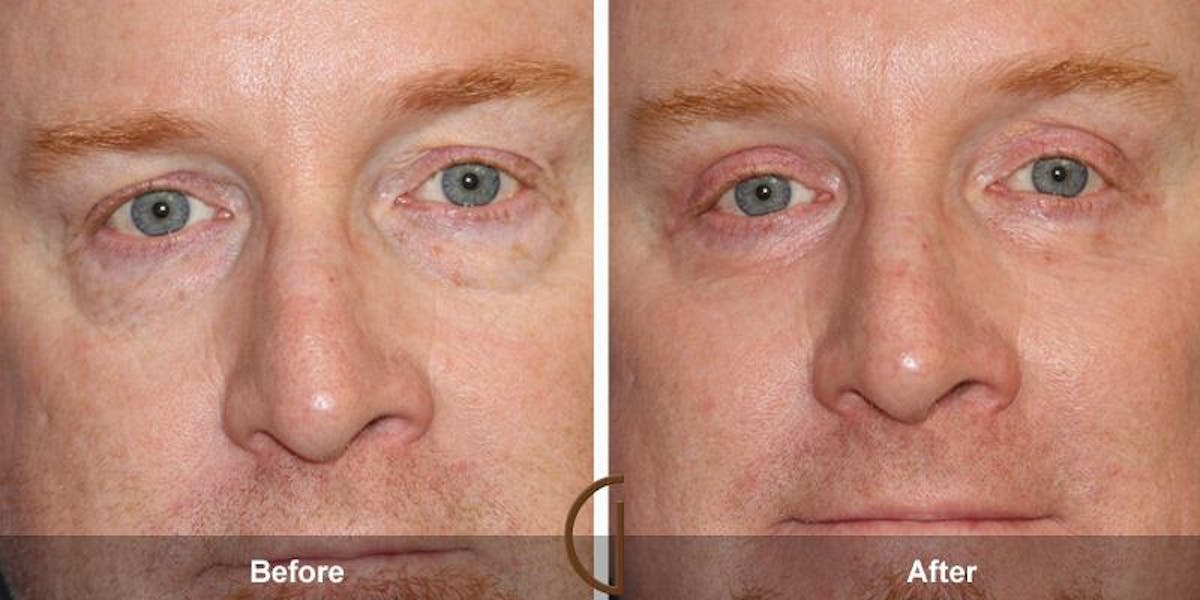Eyelid Lift Before & After Gallery - Patient 732860 - Image 2