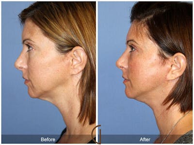 Eyelid Lift Before & After Gallery - Patient 476029 - Image 1