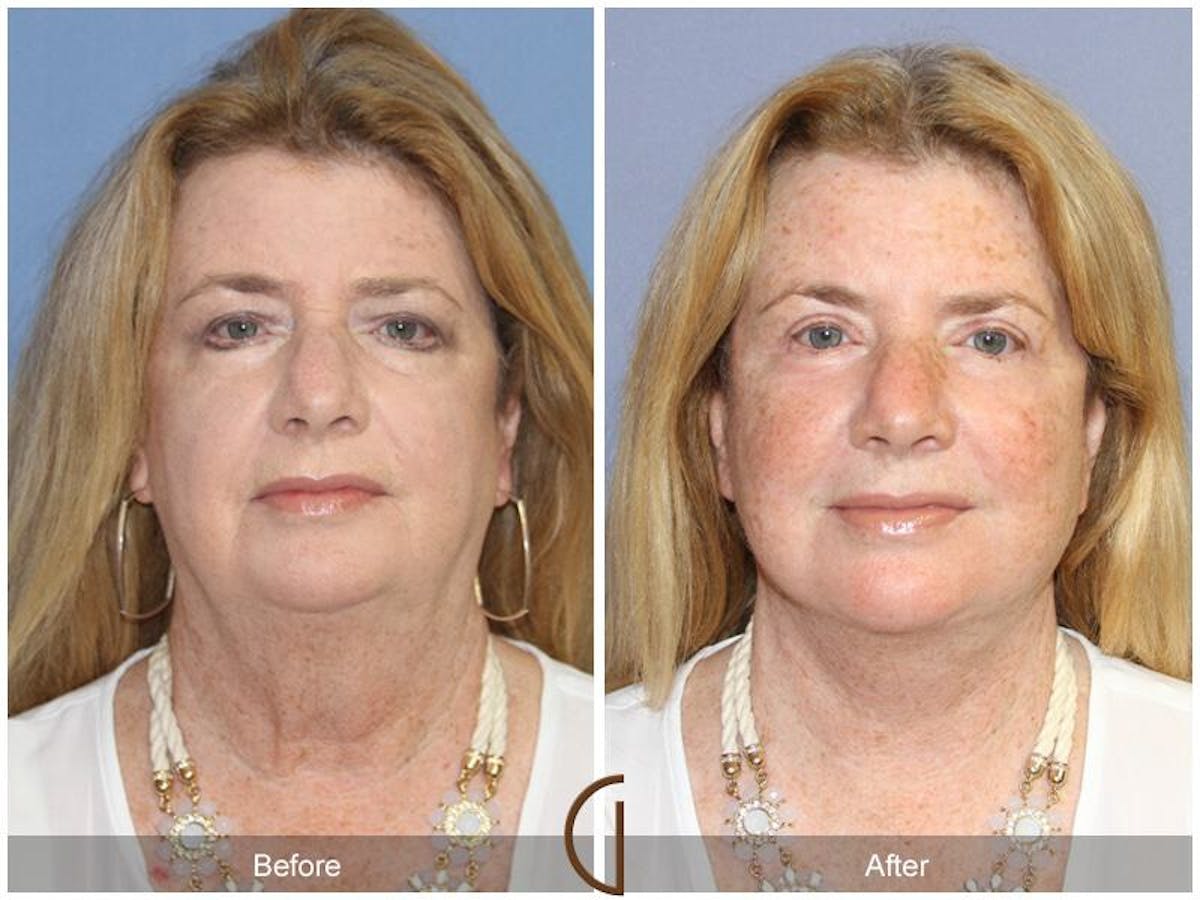 Eyelid Lift Before & After Gallery - Patient 179277 - Image 2