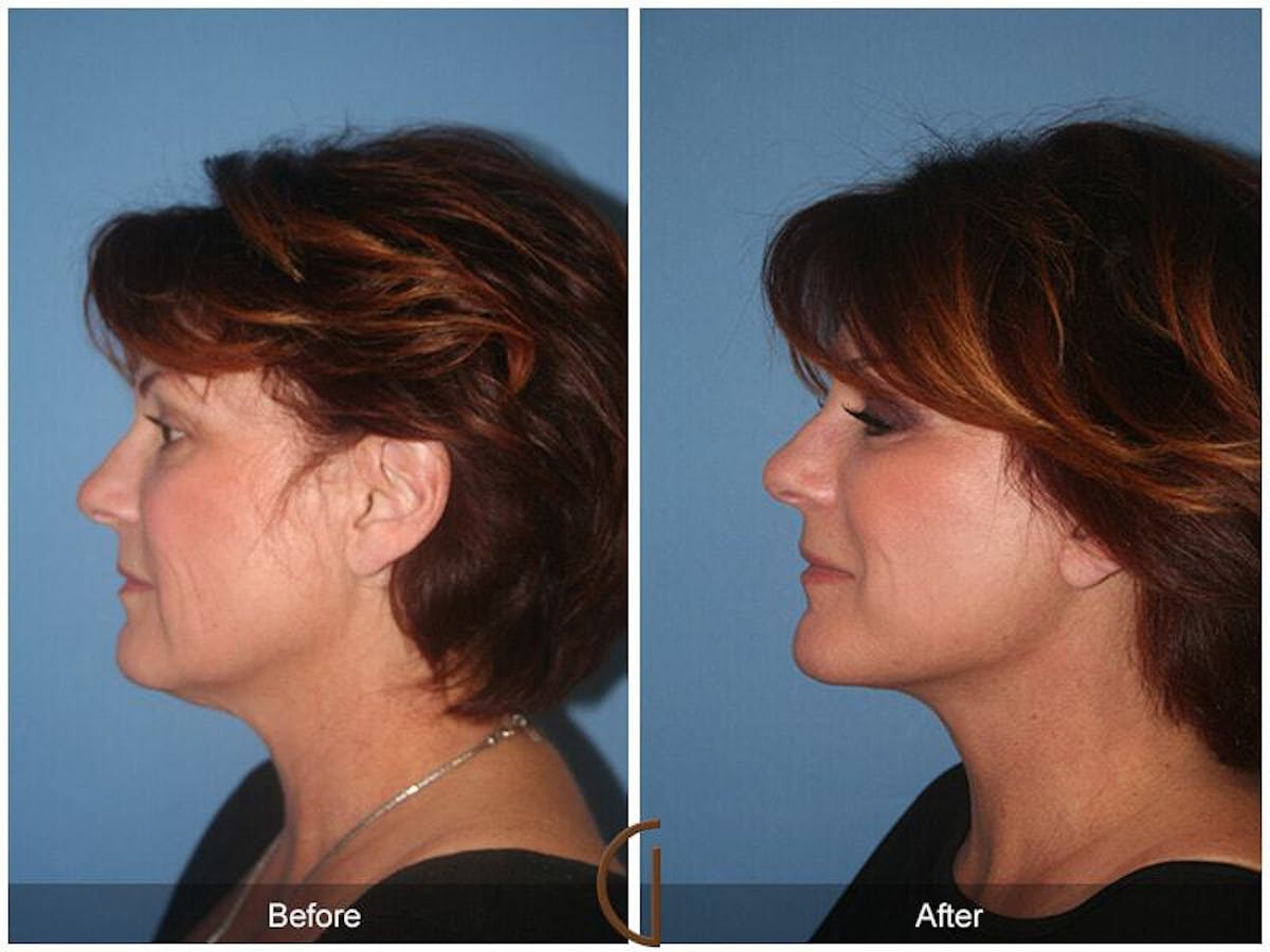 Eyelid Lift Before & After Gallery - Patient 276125 - Image 1