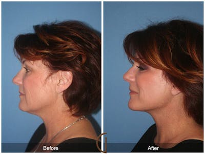 Eyelid Lift Before & After Gallery - Patient 276125 - Image 1