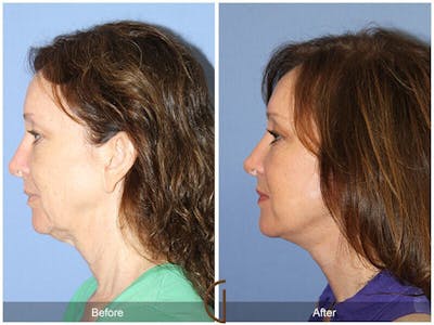 Eyelid Lift Before & After Gallery - Patient 151573 - Image 1