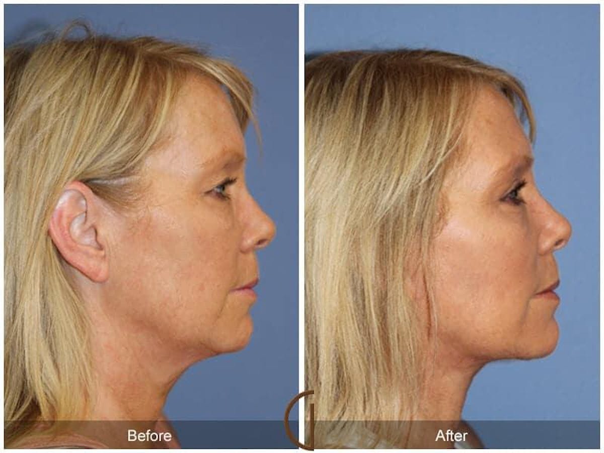 Eyelid Lift Before & After Gallery - Patient 627028 - Image 3