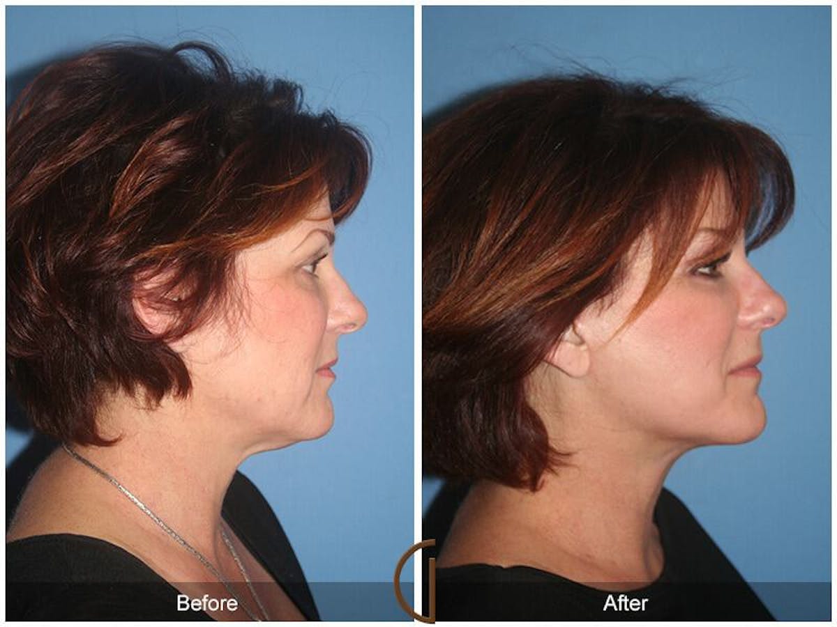 Eyelid Lift Before & After Gallery - Patient 276125 - Image 3