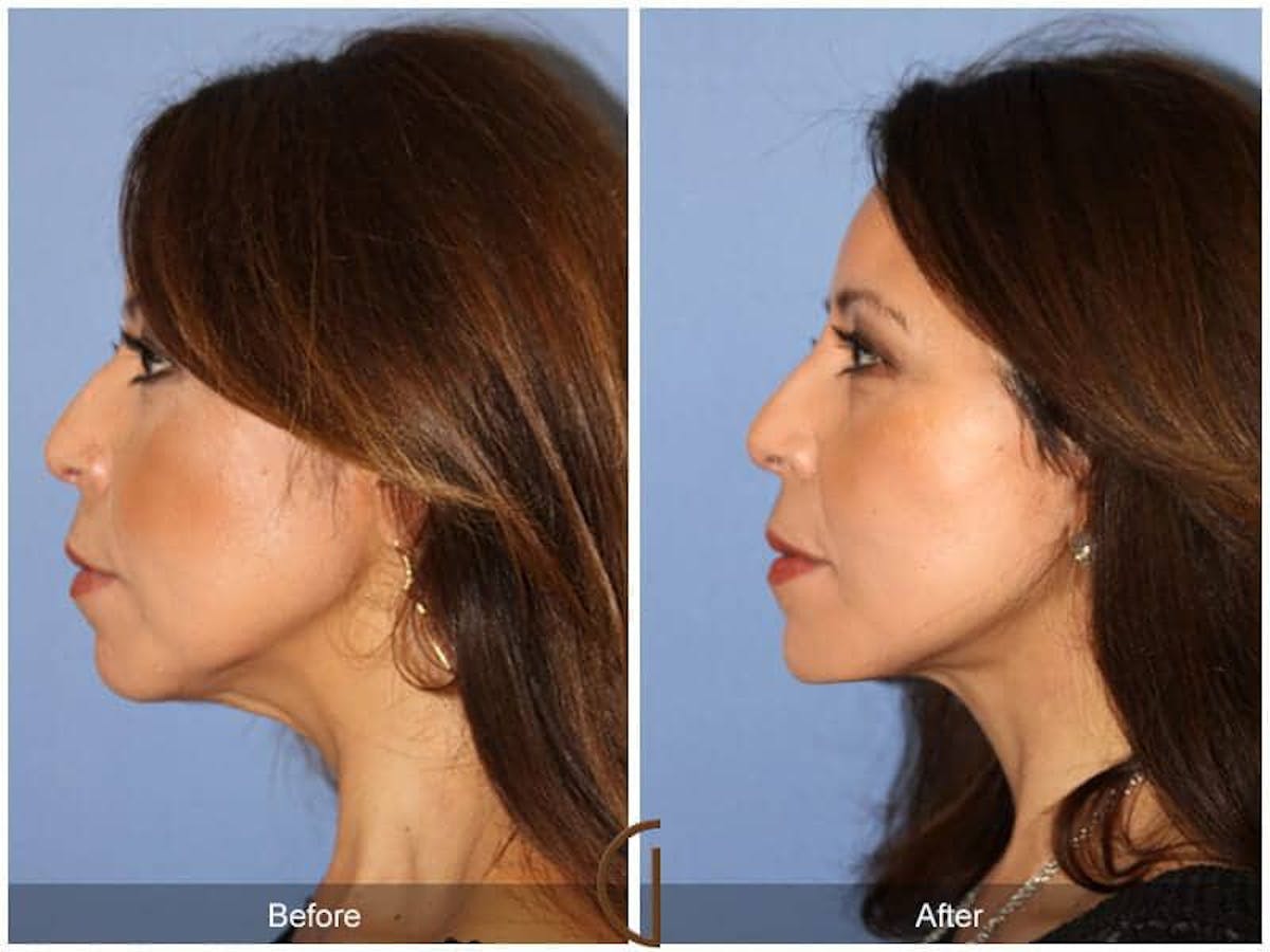 Eyelid Lift Before & After Gallery - Patient 108360 - Image 1
