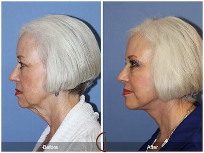 Eyelid Lift Before & After Gallery - Patient 116046 - Image 1