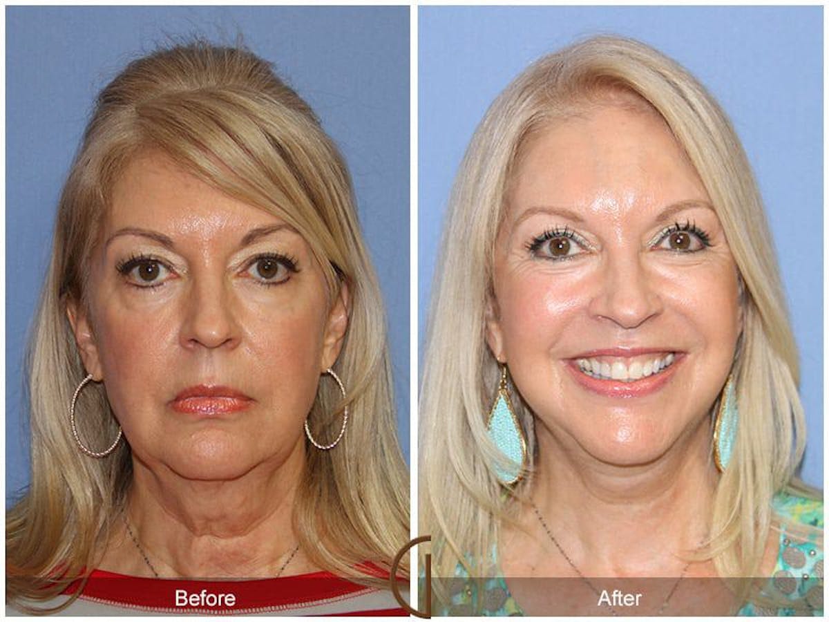 Eyelid Lift Before & After Gallery - Patient 327478 - Image 2