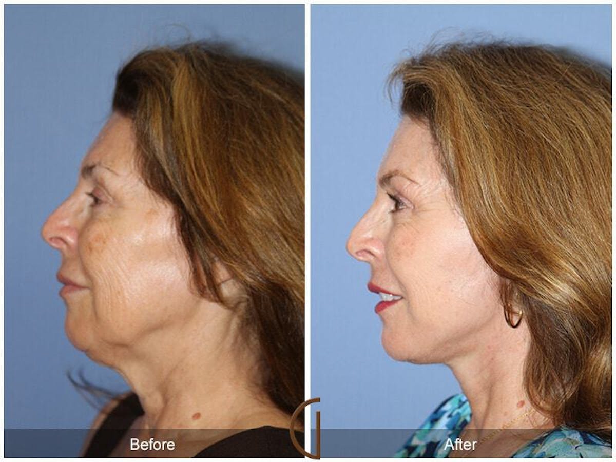 Eyelid Lift Before & After Gallery - Patient 714767 - Image 1