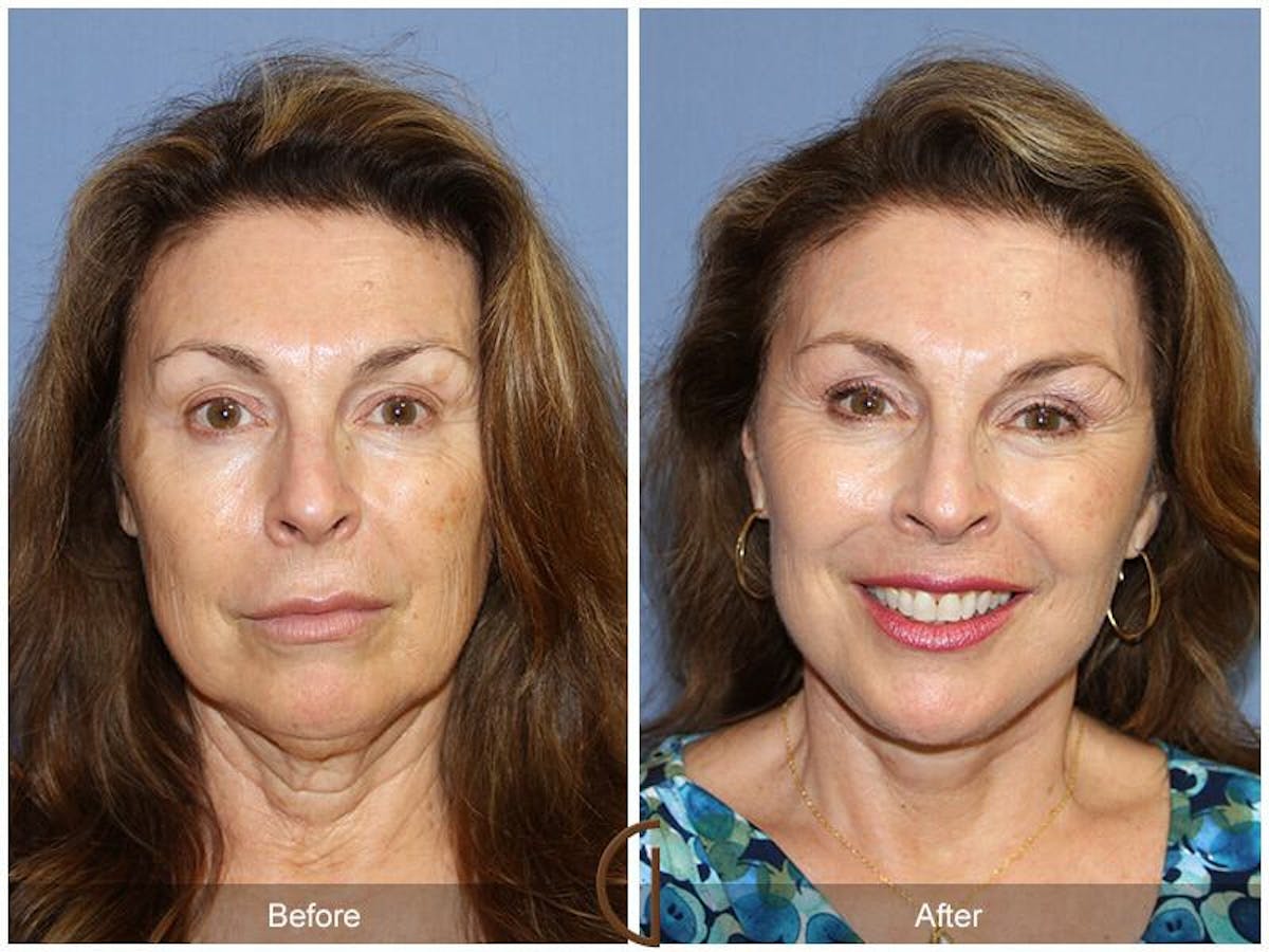 Eyelid Lift Before & After Gallery - Patient 714767 - Image 2