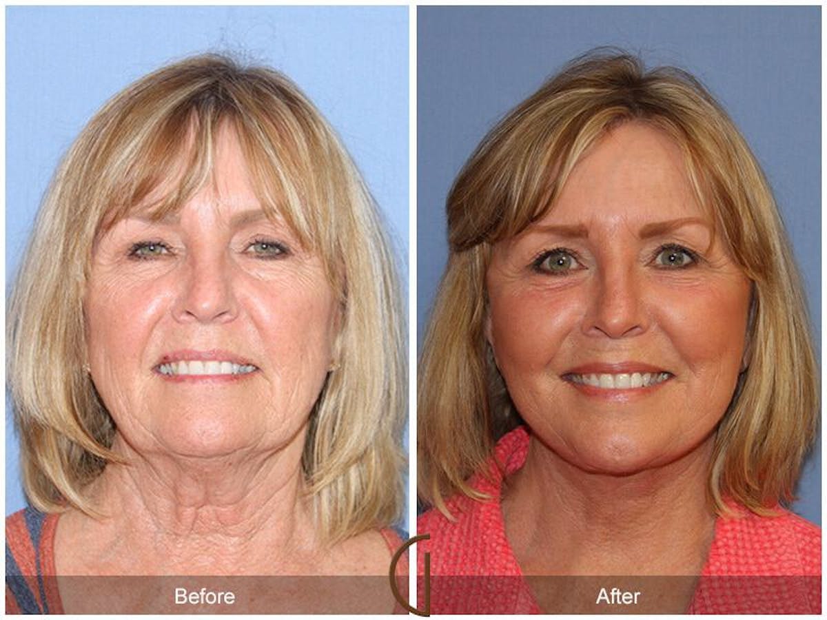 Eyelid Lift Before & After Gallery - Patient 233217 - Image 2