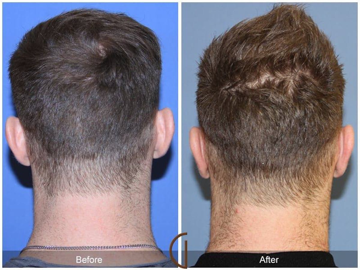 Ear Surgery Before & After Gallery - Patient 110431 - Image 1