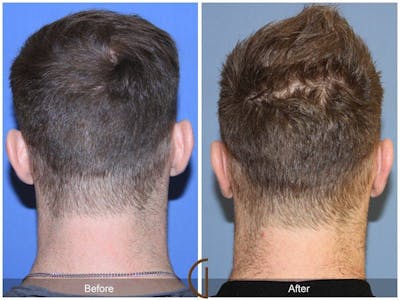 Ear Surgery Before & After Gallery - Patient 110431 - Image 1