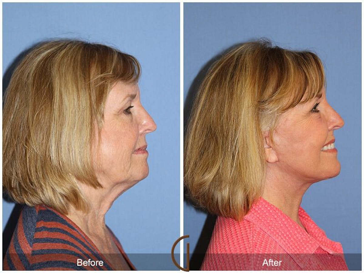 Eyelid Lift Before & After Gallery - Patient 233217 - Image 3