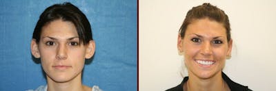 Ear Surgery Before & After Gallery - Patient 602024 - Image 1
