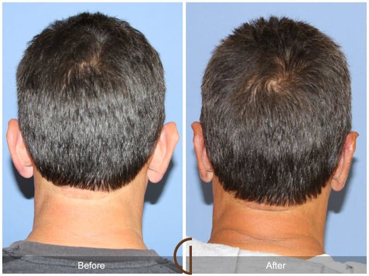 Ear Surgery Before & After Gallery - Patient 184066 - Image 1