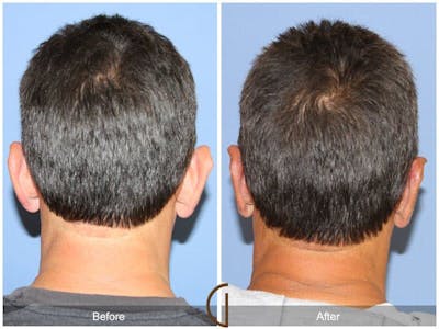 Ear Surgery Before & After Gallery - Patient 184066 - Image 1