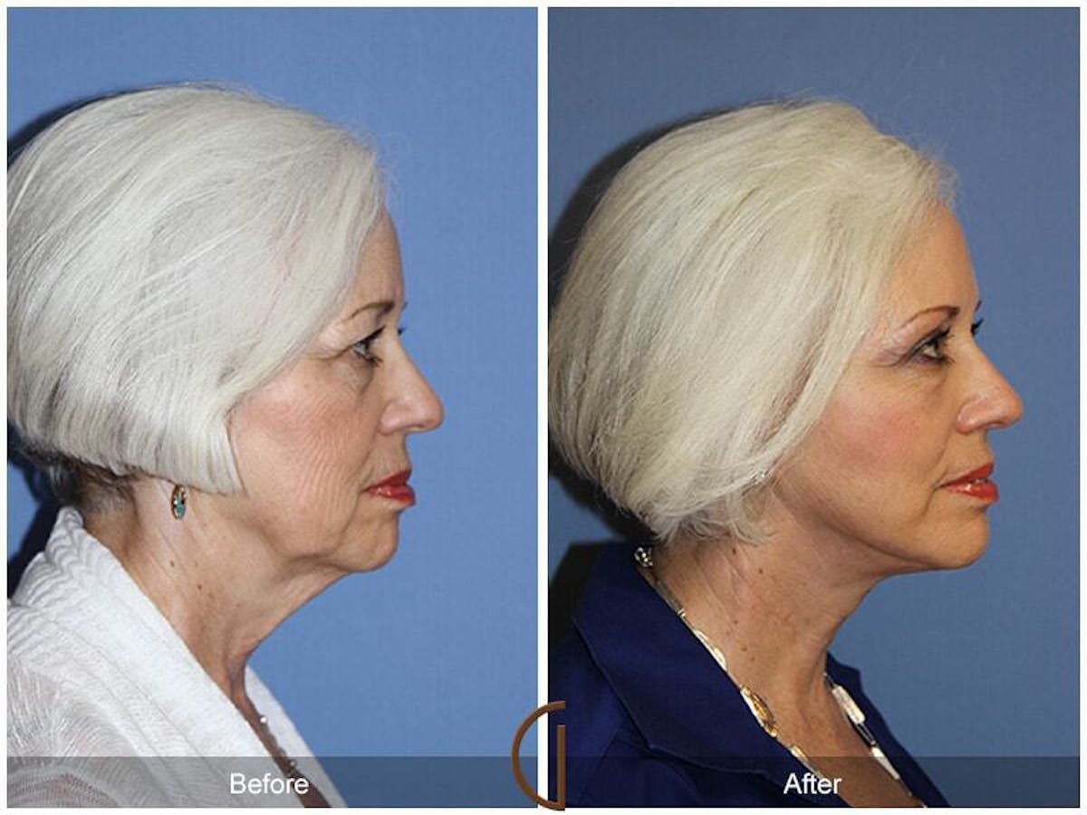 Eyelid Lift Before & After Gallery - Patient 116046 - Image 3
