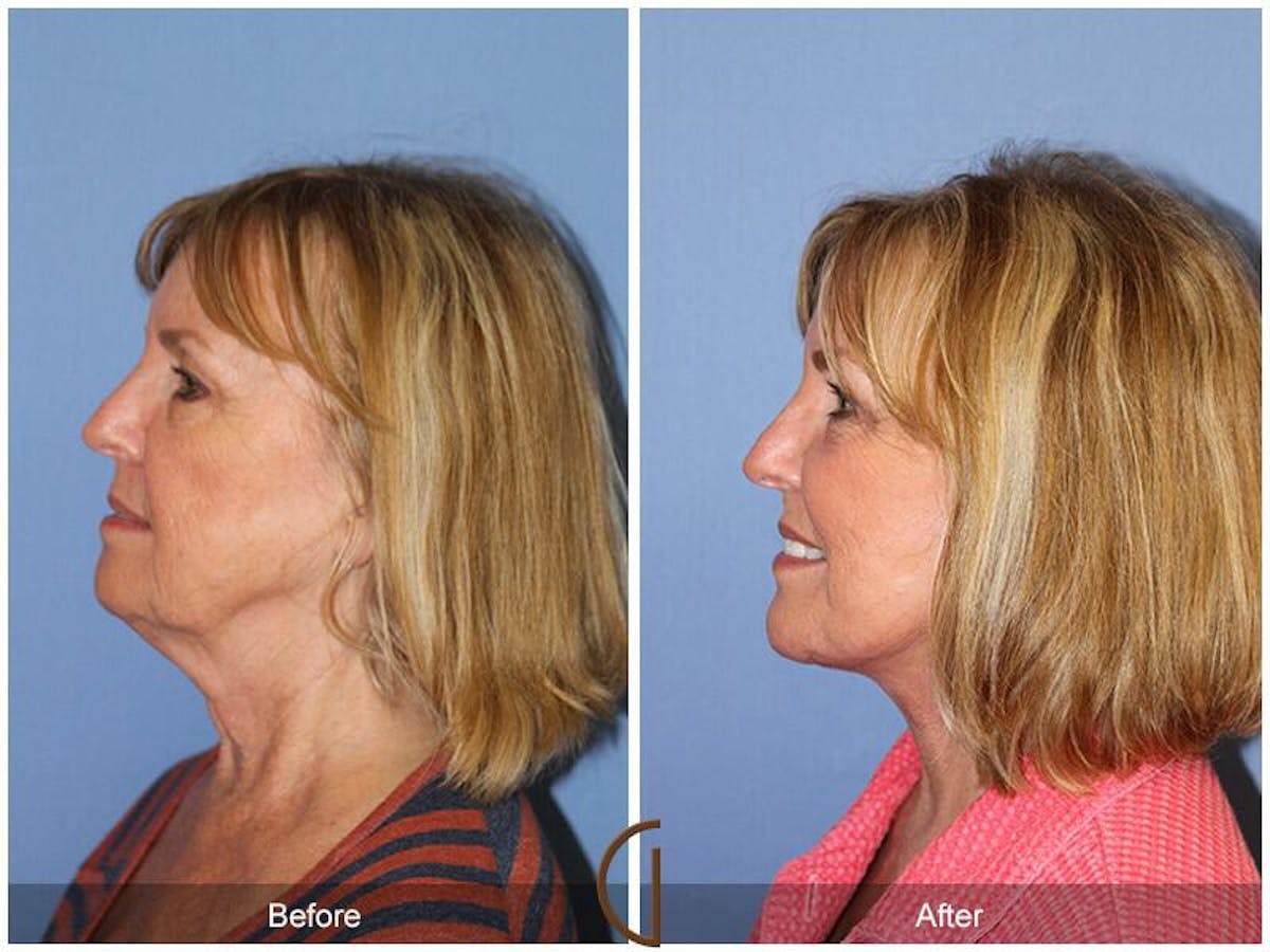 Eyelid Lift Before & After Gallery - Patient 233217 - Image 1