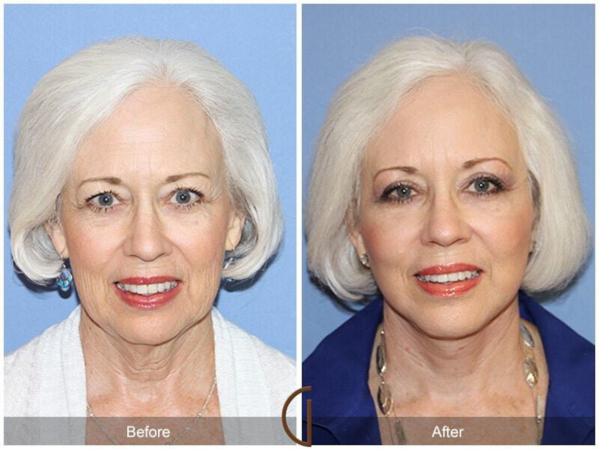 Eyelid Lift Before & After Gallery - Patient 116046 - Image 2