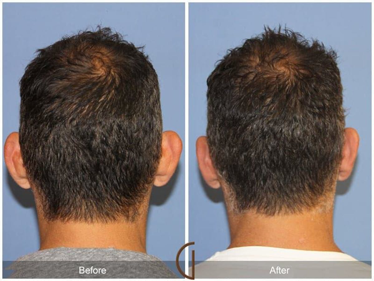 Ear Surgery Before & After Gallery - Patient 159447 - Image 1