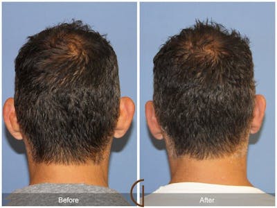 Ear Surgery Before & After Gallery - Patient 159447 - Image 1