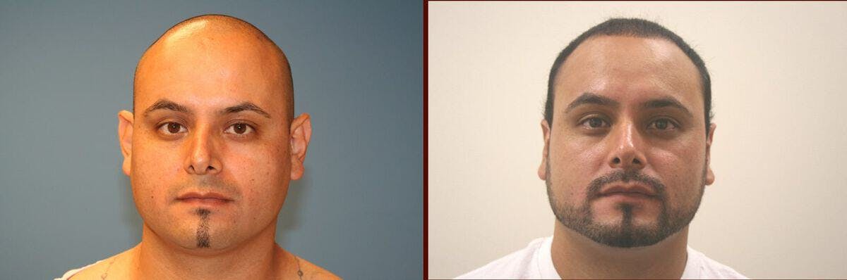 Ear Surgery Before & After Gallery - Patient 101584 - Image 1
