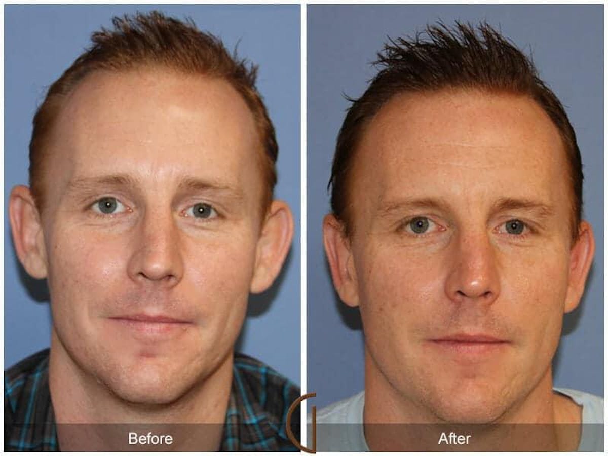 Ear Surgery Before & After Gallery - Patient 454066 - Image 2