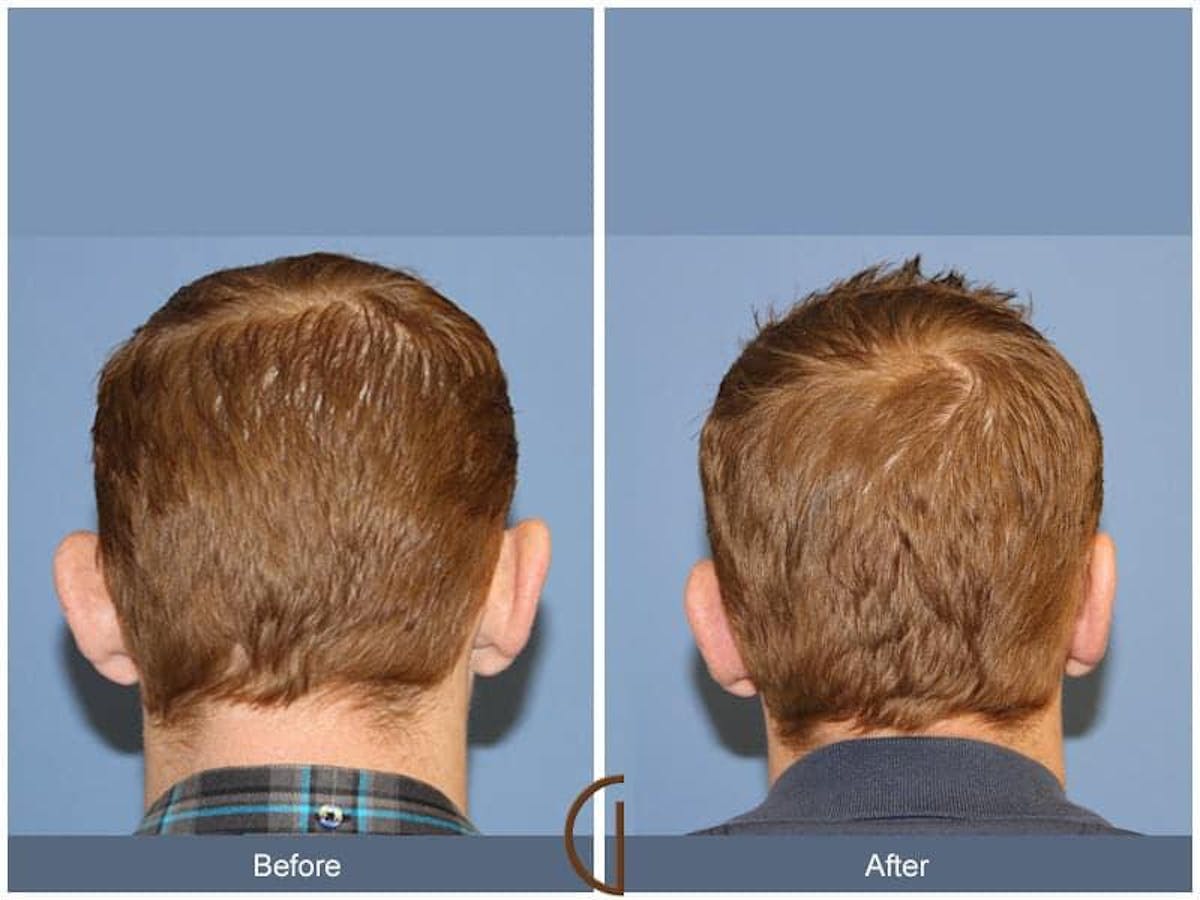 Ear Surgery Before & After Gallery - Patient 454066 - Image 1