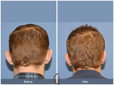 Ear Surgery Before & After Gallery - Patient 454066 - Image 1