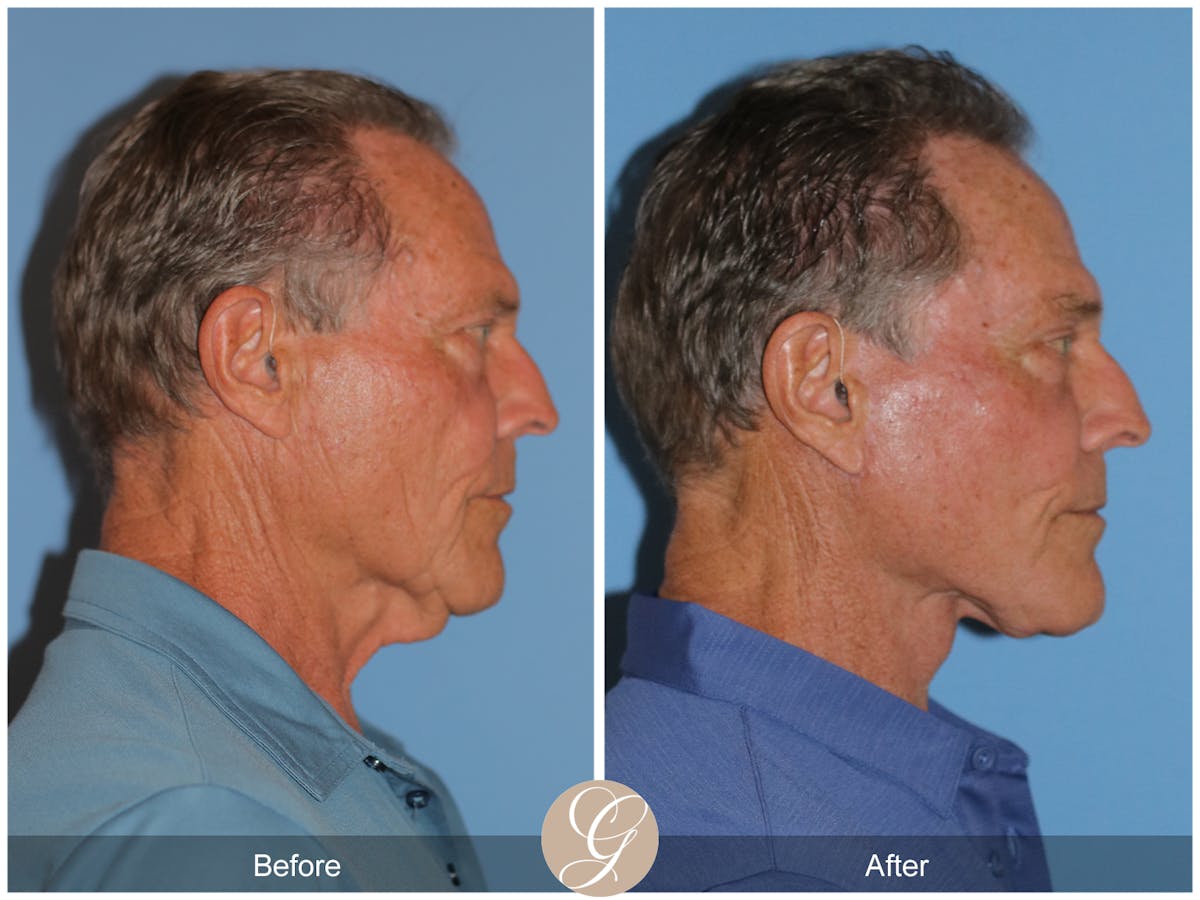 Preservation Facelift Before & After Gallery - Patient 528523 - Image 5