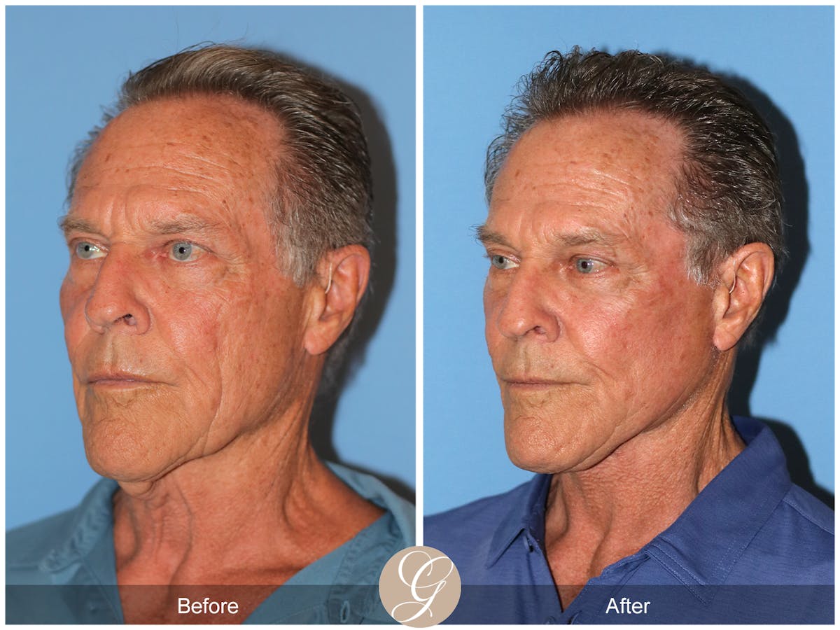 Preservation Facelift Before & After Gallery - Patient 528523 - Image 6