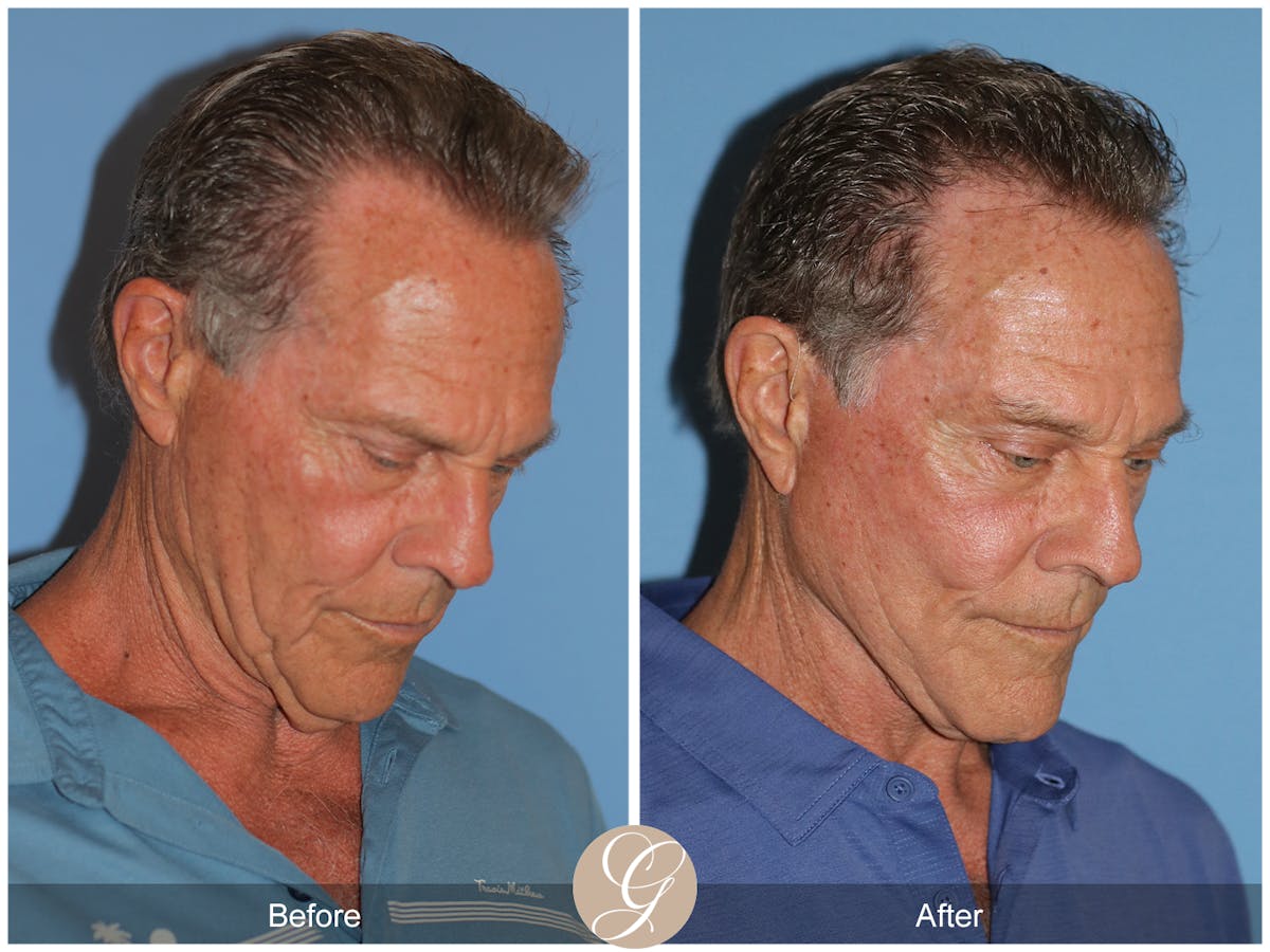 Preservation Facelift Before & After Gallery - Patient 528523 - Image 4