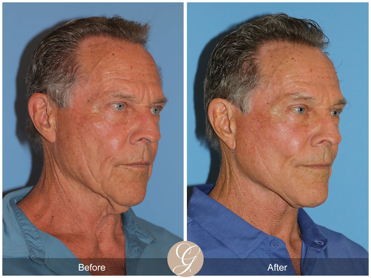 Preservation Facelift Before & After Gallery - Patient 528523 - Image 3