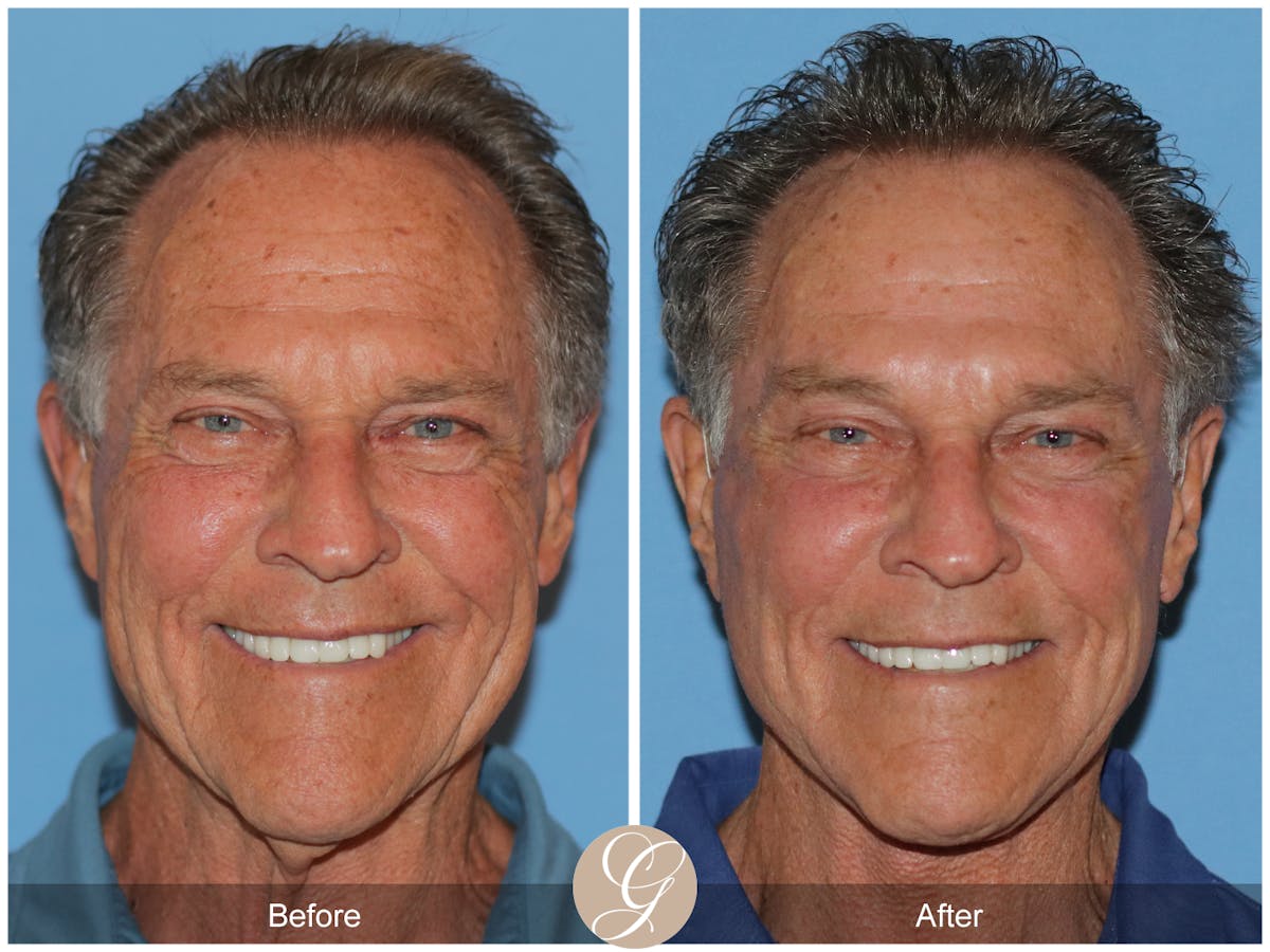 Preservation Facelift Before & After Gallery - Patient 528523 - Image 1