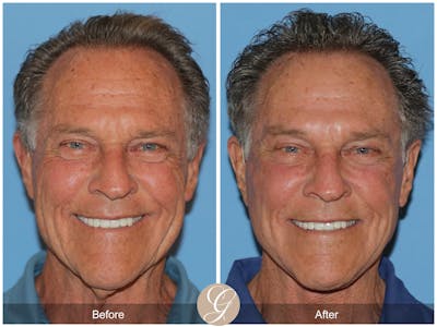 Preservation Facelift Before & After Gallery - Patient 528523 - Image 1