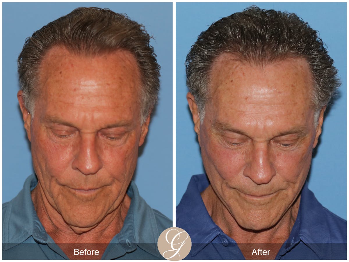 Preservation Facelift Before & After Gallery - Patient 528523 - Image 2