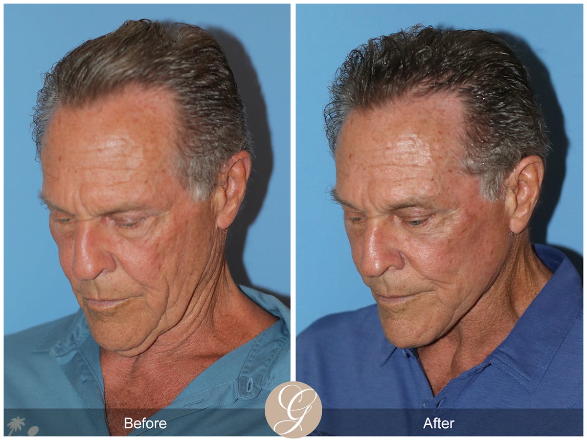 Preservation Facelift Before & After Gallery - Patient 528523 - Image 7