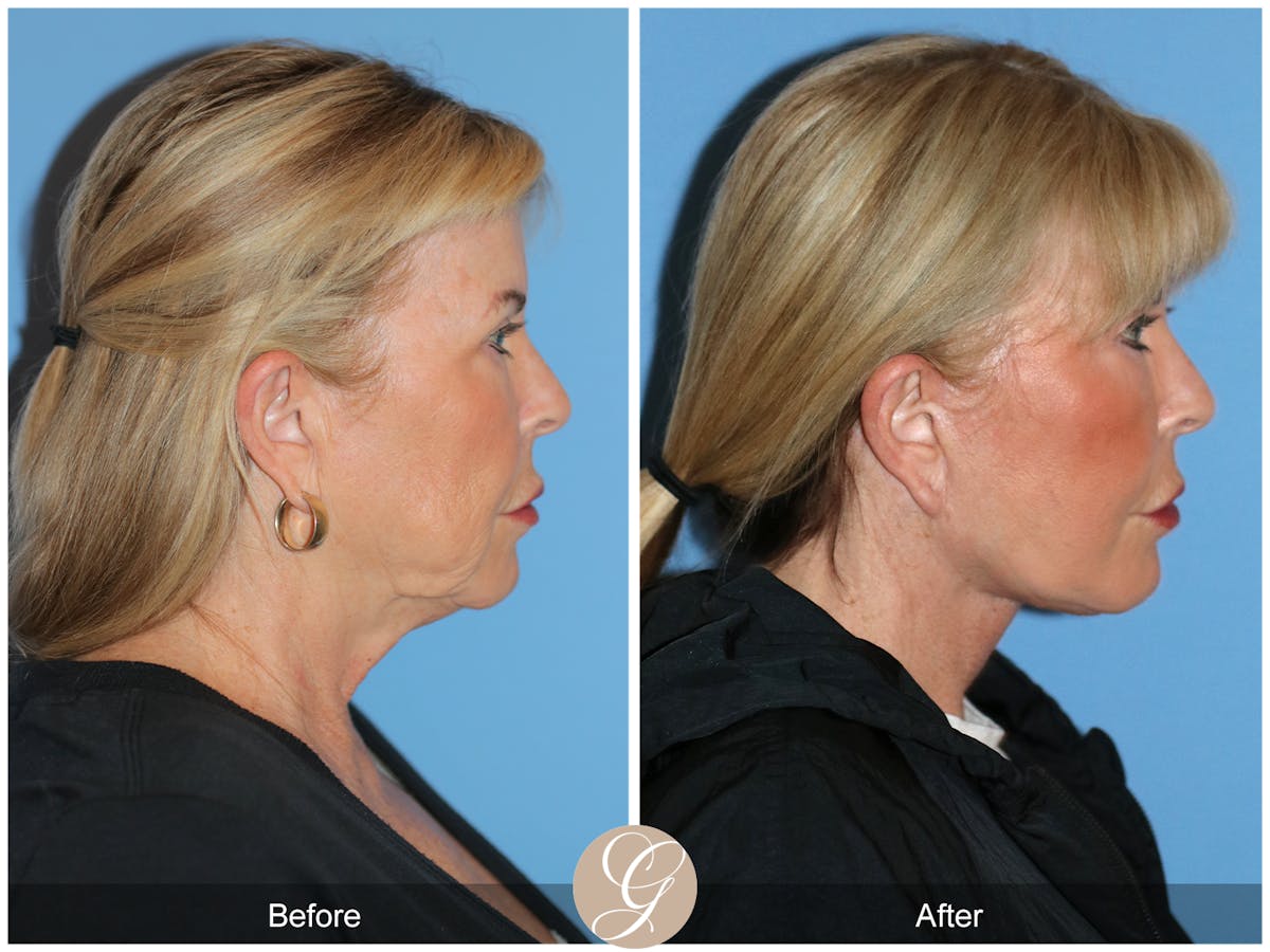 Preservation Facelift Before & After Gallery - Patient 220003 - Image 5