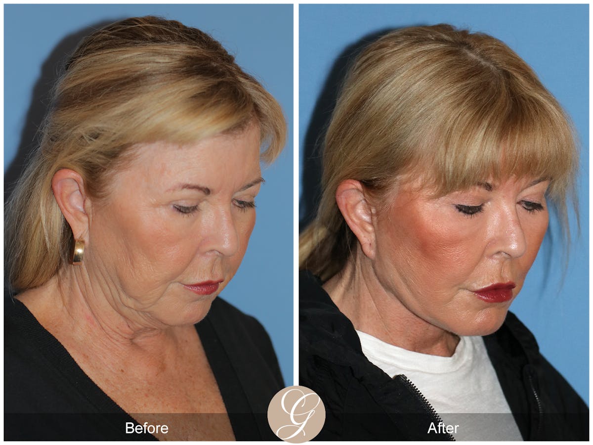 Preservation Facelift Before & After Gallery - Patient 220003 - Image 4