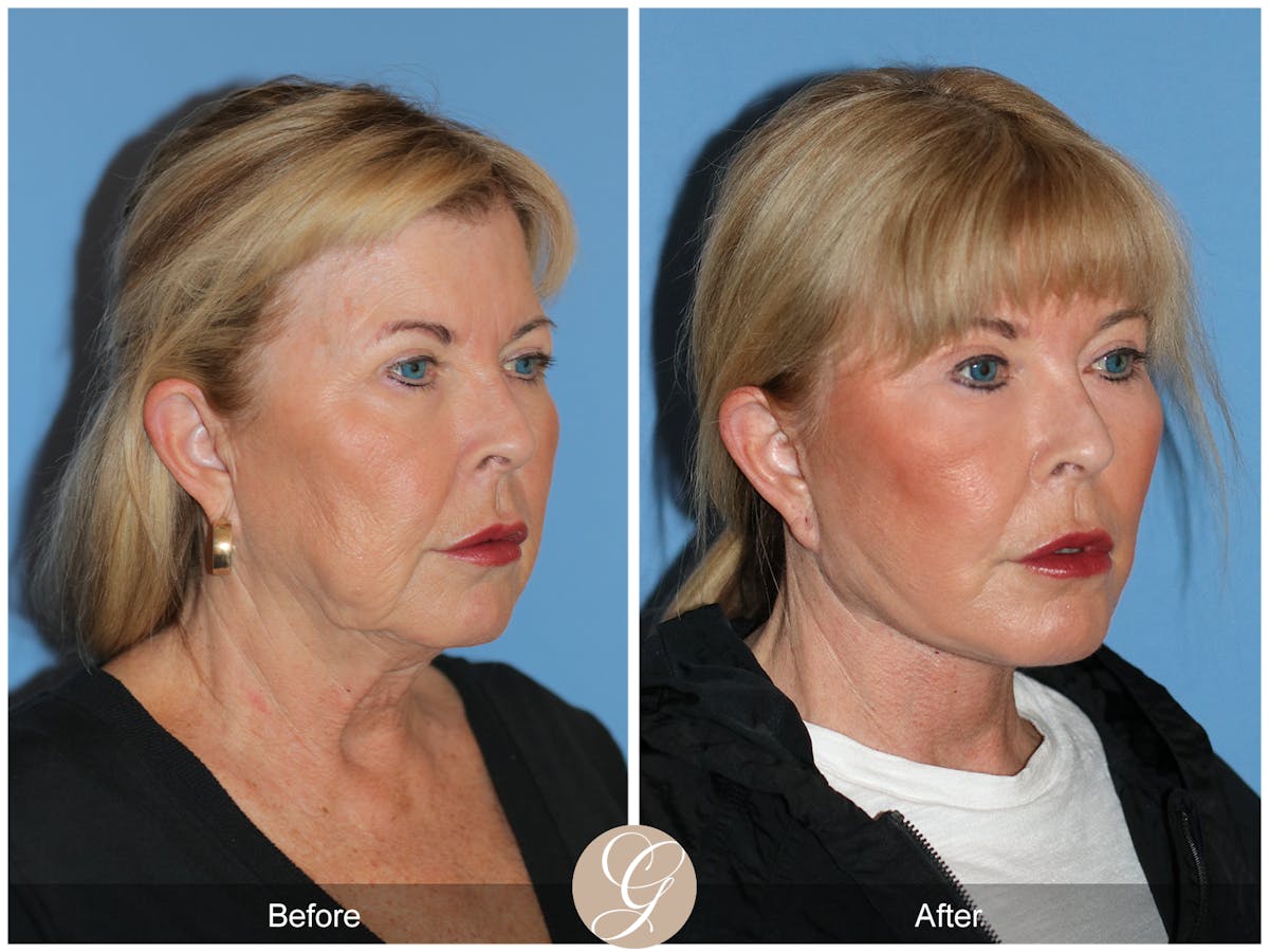 Preservation Facelift Before & After Gallery - Patient 220003 - Image 3